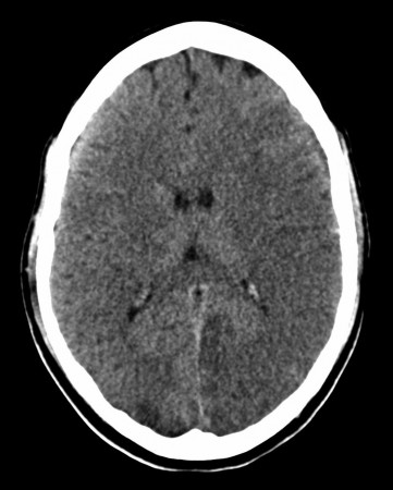 Acute infarct – CT