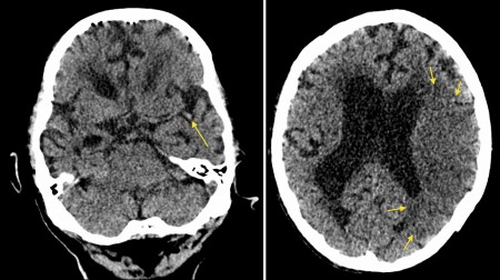 Acute MCA infarct – dot sign