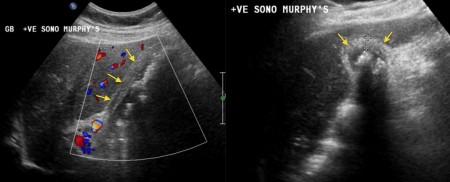 Acute cholecystitis