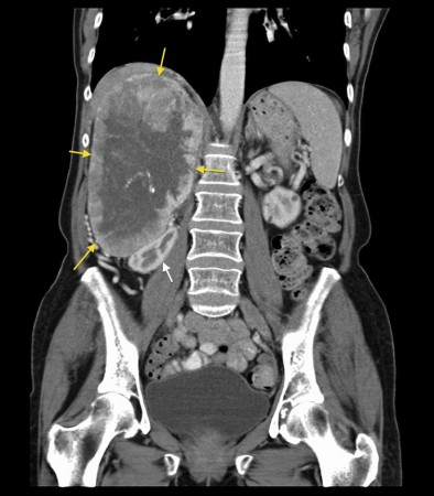 Phaeochromocytoma