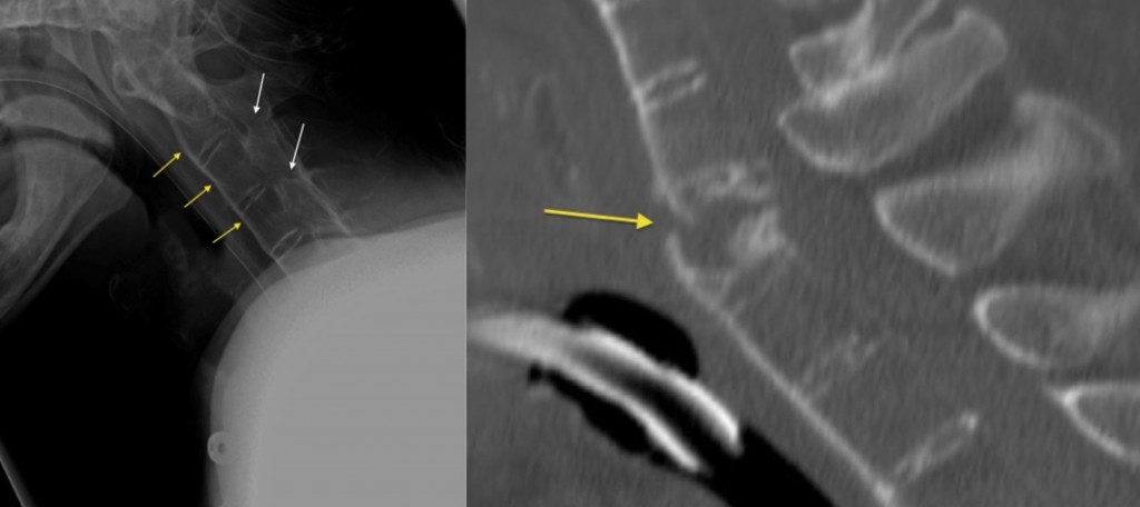 Ankylosing Spondylitis With Fracture Radiology At St Vincents