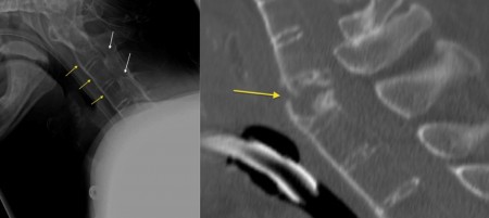 Ankylosing spondylitis with fracture