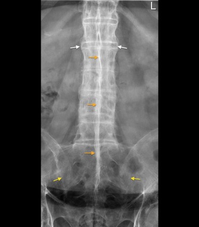 Ankylosing spondylitis – dagger sign