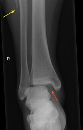 Maisonneuve fracture - Radiology at St. Vincent's University Hospital