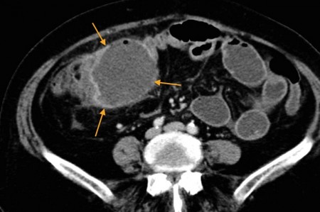 Appendix abscess