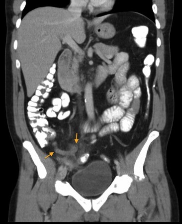 Acute Appendicitis