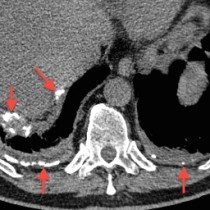 Lung cancer in patient with previous asbestos exposure  Radiology at St. Vincent\u002639;s University 