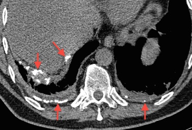 Pleural plaques from asbestos exposure – CT