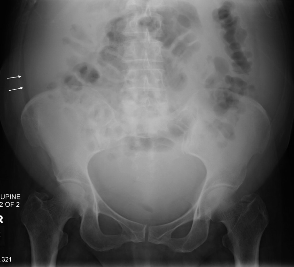 Ascites – radiograph - Radiology at St. Vincent's University Hospital