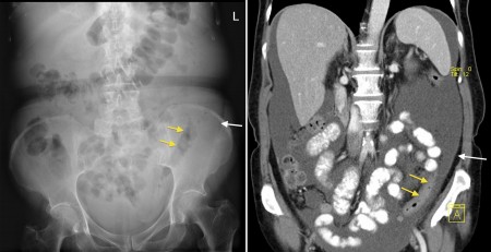 Ascites – x-ray and CT