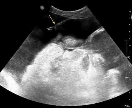 Ascites with drainage