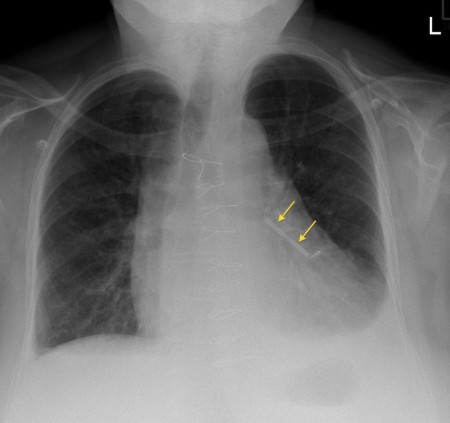 Atrial appendage closure device