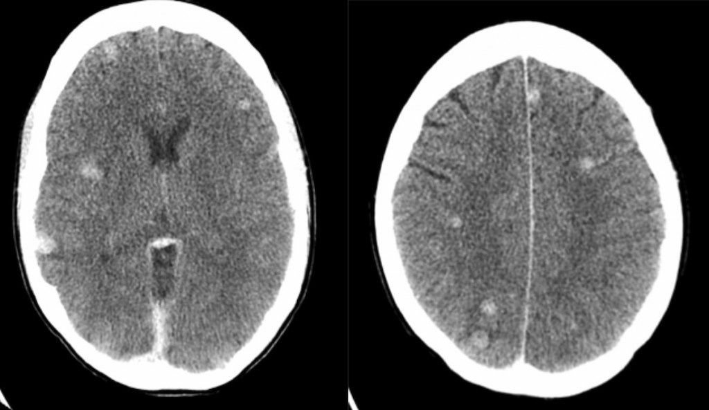 Brain metastases - Radiology at St. Vincent's University Hospital