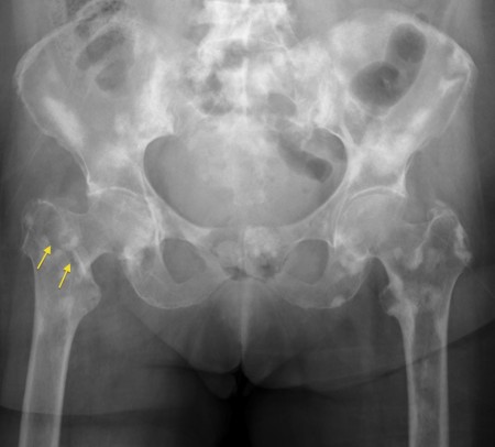 Sclerotic Bone Metastases