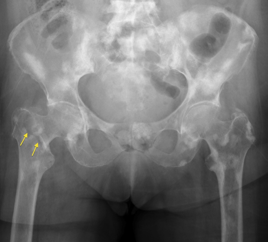 Sclerotic Bone Metastases - Radiology at St. Vincent's University Hospital