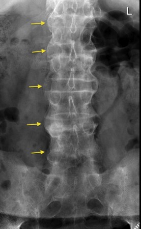 Bamboo spine of ankylosing spondylitis