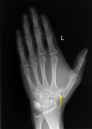 Bennett’s fracture