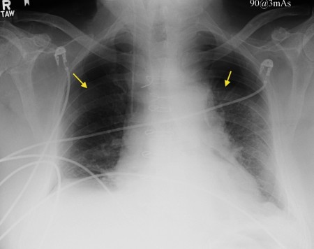 Pneumothorax from central line insertion