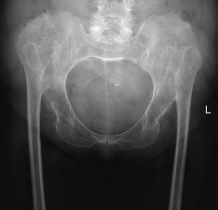 Developmental dysplasia of the hips (2)