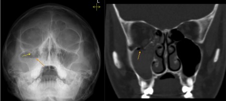 Orbital blowout fracture