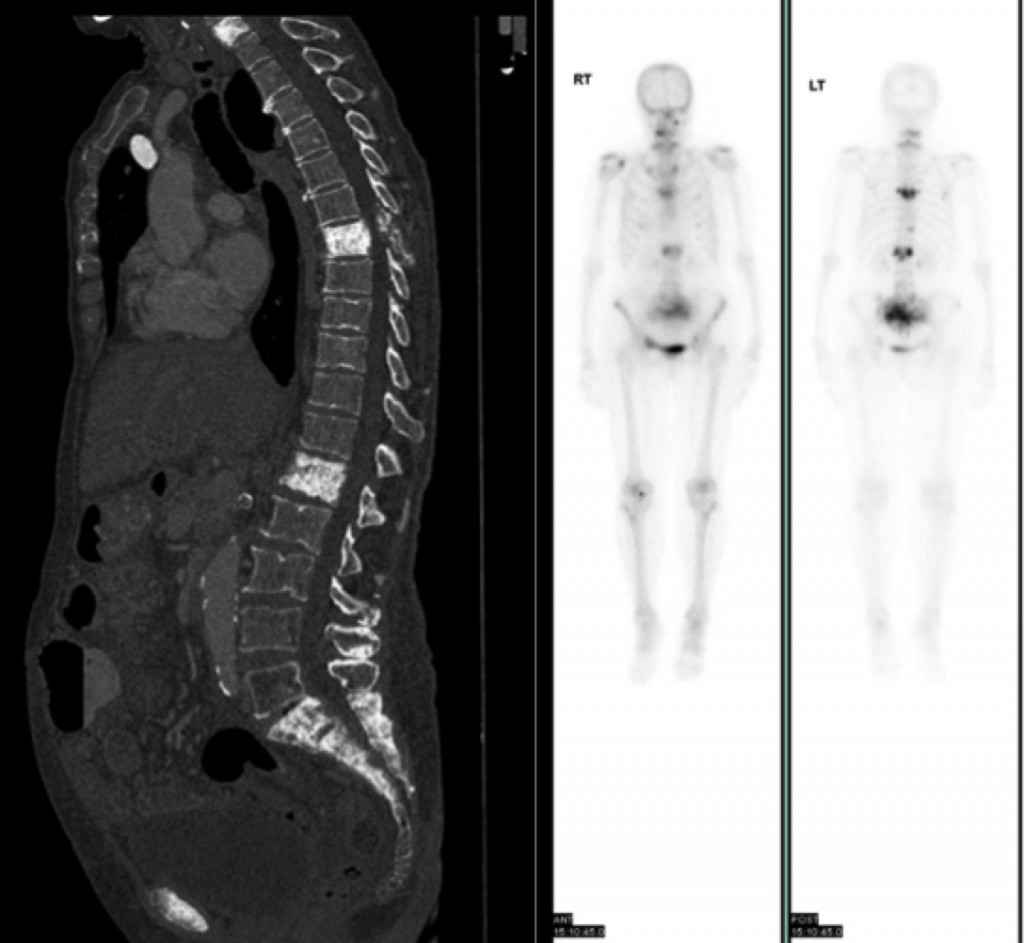 Bone metastases - CT and bone scan - Radiology at St. Vincent's