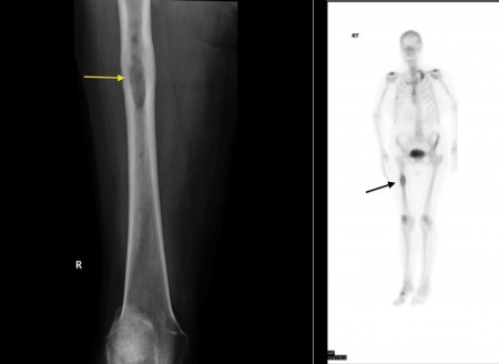 Bone metastasis