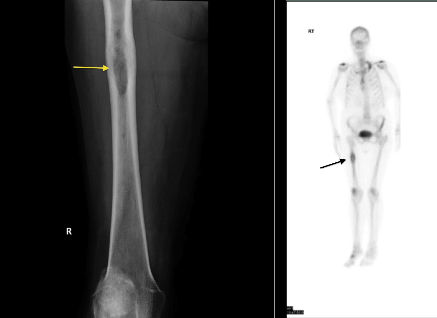 Bone metastasis - Radiology at St. Vincent's University Hospital