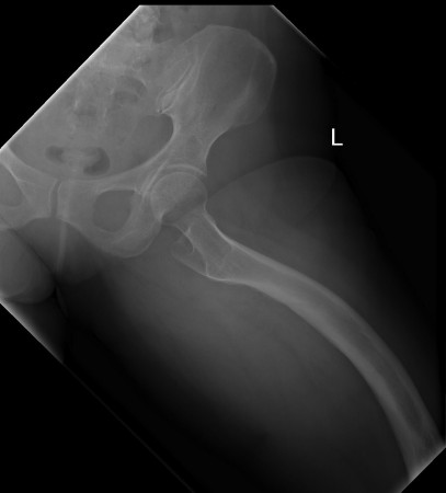 Bowed femur