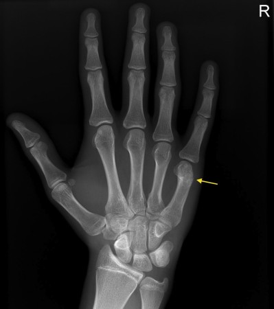 Boxer’s fracture