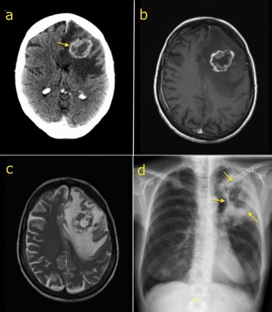 Brain metastasis