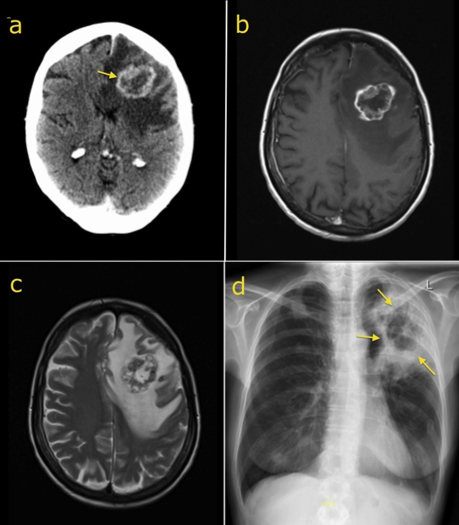 Brain metastasis - Radiology at St. Vincent's University Hospital