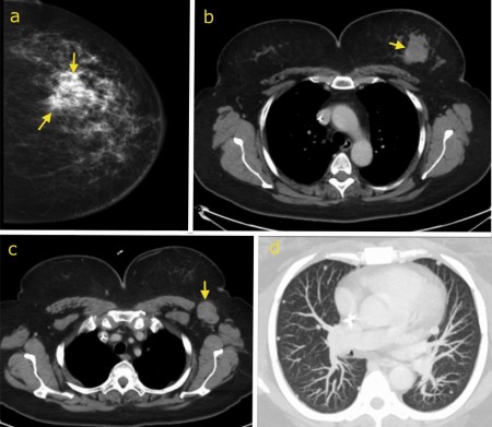 Metastatic breast cancer