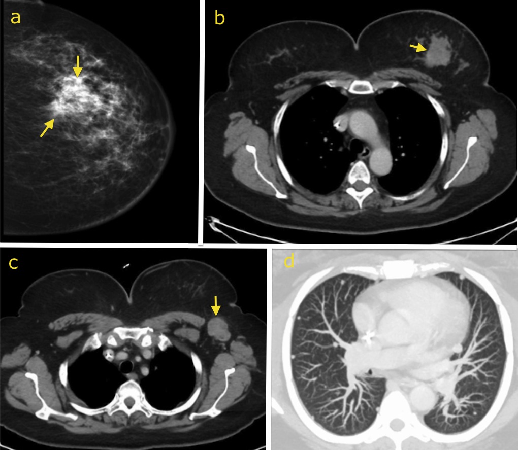 Metastatic Breast Cancer Radiology At St Vincents University Hospital