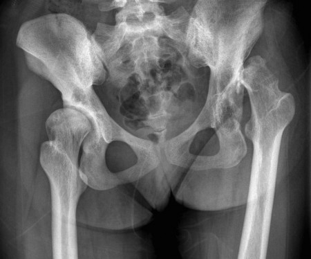 Developmental dysplasia of hips