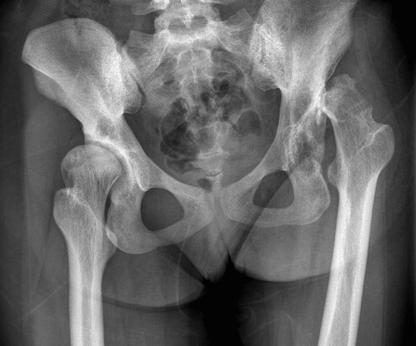 Congenital hip dysplasia hotsell