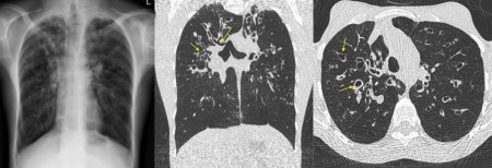 Cystic fibrosis