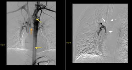 Bronchial artery embolization