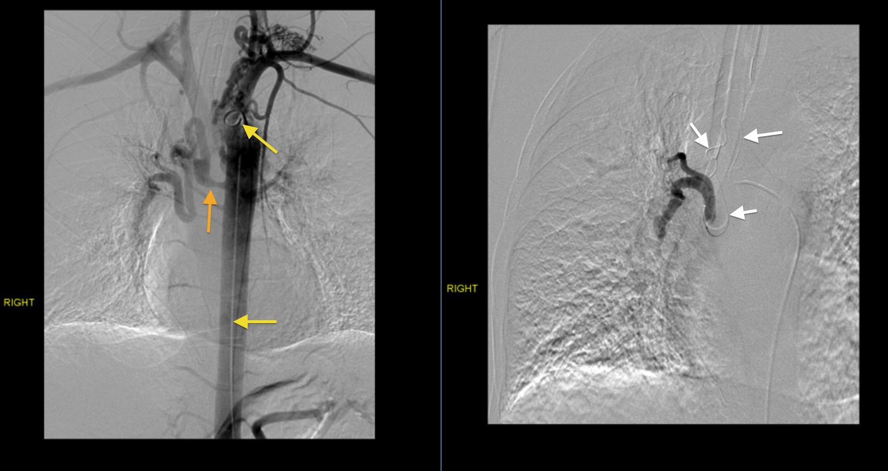 Bronchial artery embolization - Radiology at St. Vincent's University