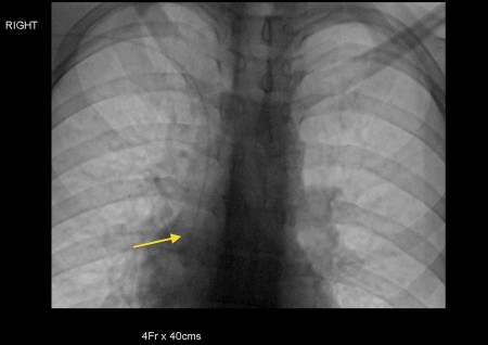 Peripherally inserted central catheter (PICC)