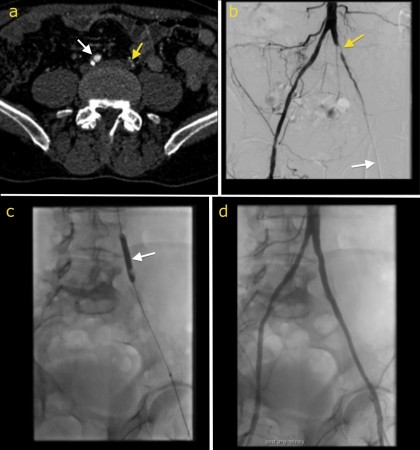 Iliac artery stenting