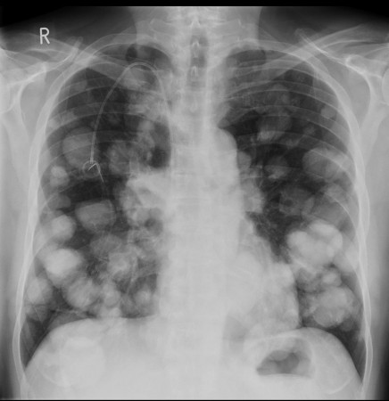 Cannonball metastases – colorectal cancer