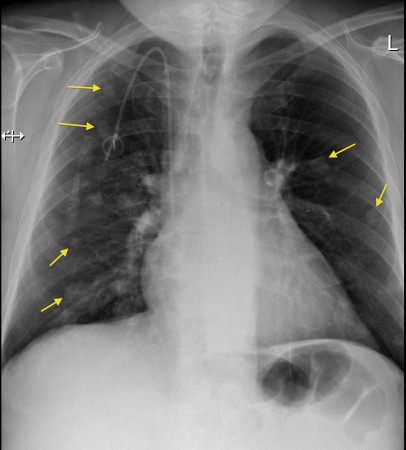 Lung metastases, portacath