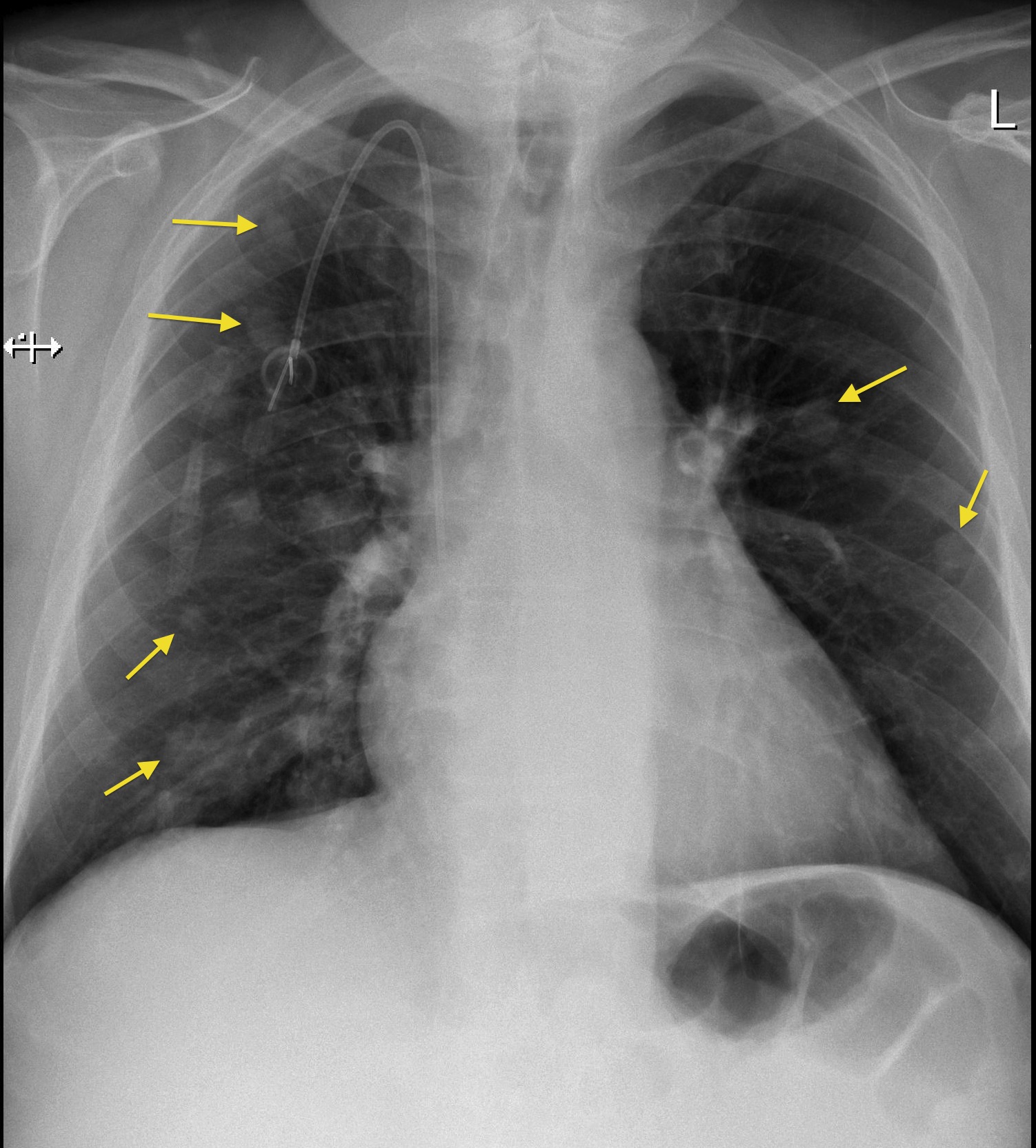 Lung metastases, portacath - Radiology at St. Vincent's University Hospital