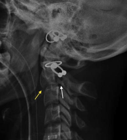 Hangman fracture