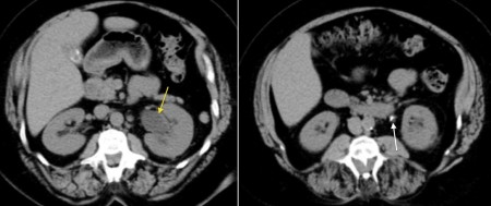 Ureteric calculus on CT KUB