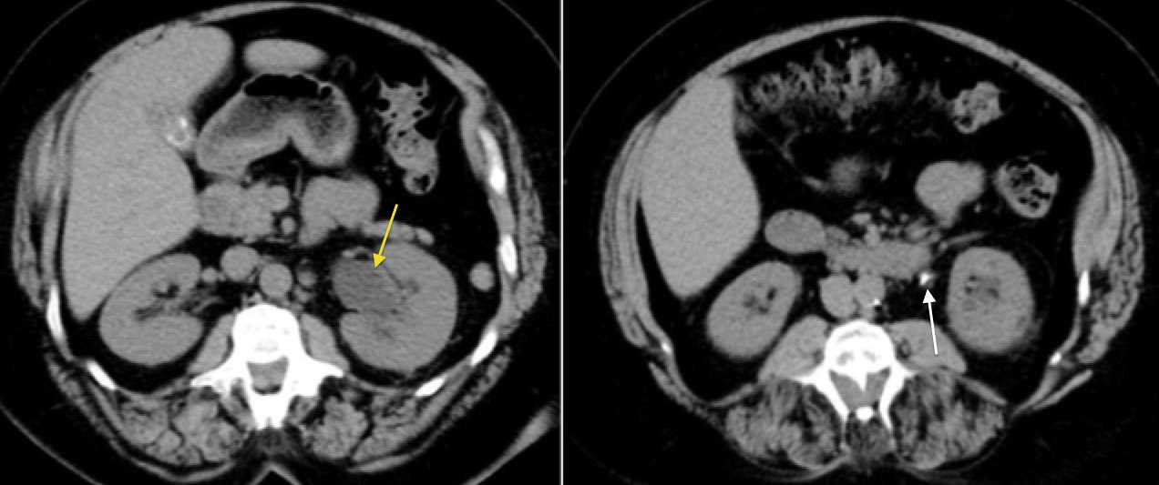 Ureteric calculus on CT KUB Radiology at St. Vincent's University