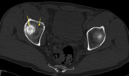 Acetabular fracture