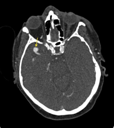 Berry aneurysm