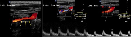 Carotid Stenosis