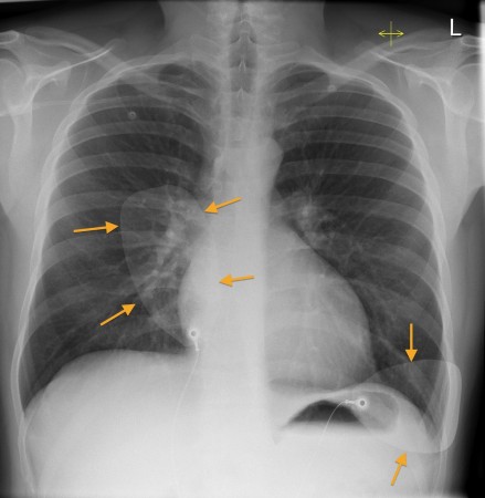 Defibrillation pads – CXR